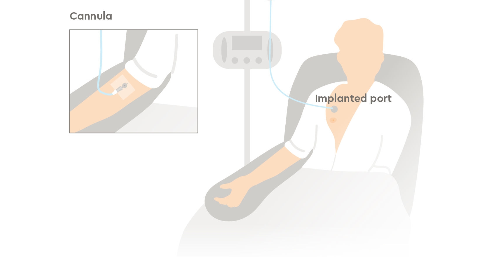 Implantable ports  Macmillan Cancer Support