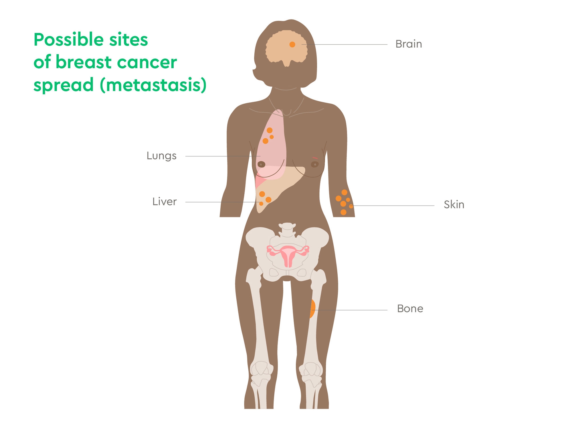 image of breast cancer spread