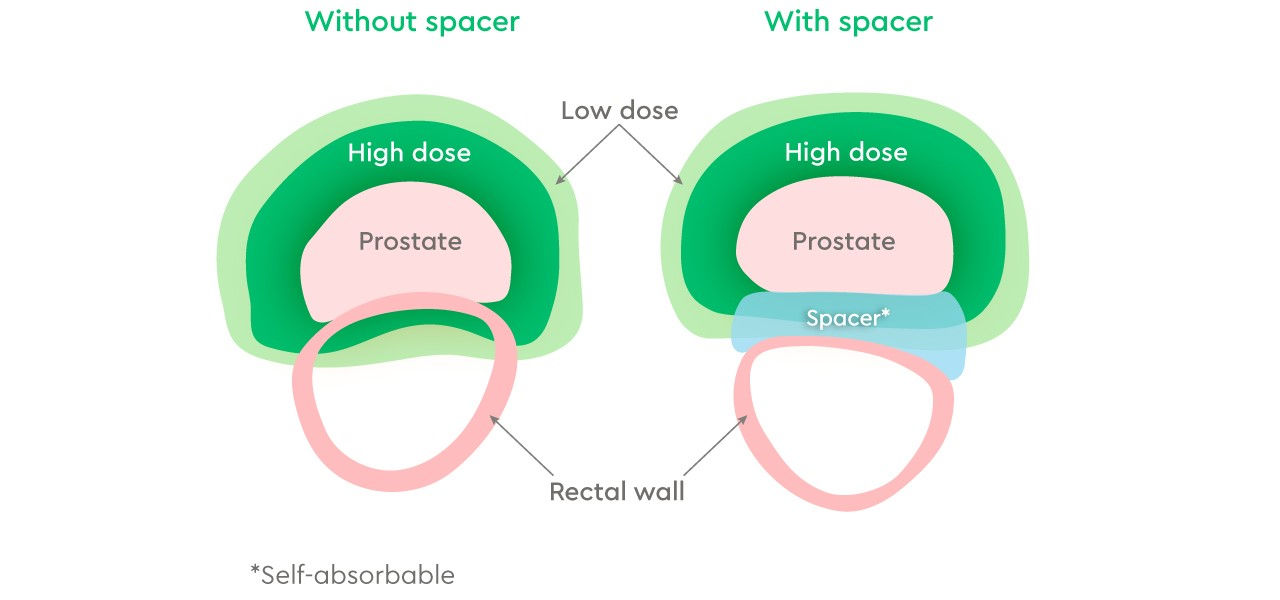 Private Prostate Cancer Treatment